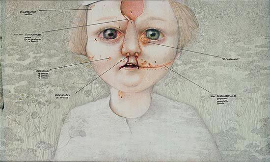 Otorhinolaryngological aspects of handicapped children in visual arts